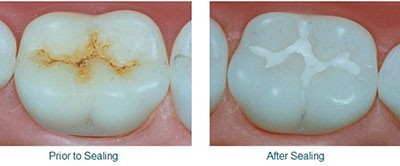 b2ap3_thumbnail_shiyarpoosh2 فواید شیار پوش برای جلوگیری از پوسیدگی دندان