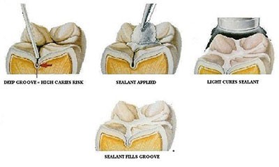 b2ap3_thumbnail_shiyarpoosh3 فواید شیار پوش برای جلوگیری از پوسیدگی دندان