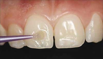 b2ap3_thumbnail_tooth-enamel-defects-1 نقص مینای دندان یا هیپوپلازی مینا